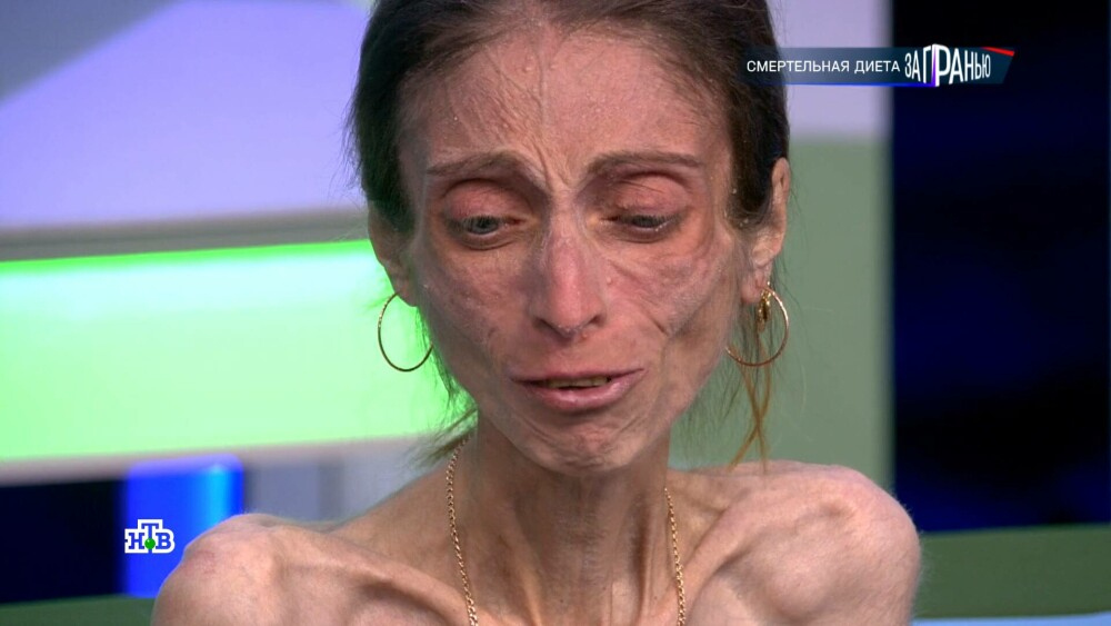 Înfiorător! Cât mănâncă, de fapt, Iana, o tânără de 17 de kilograme