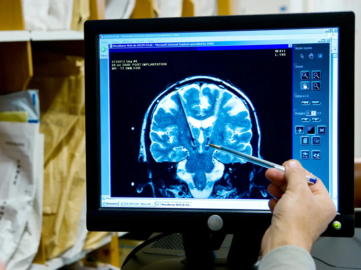 A.I. decodează gândurile în vorbire pentru pacienții AVC​