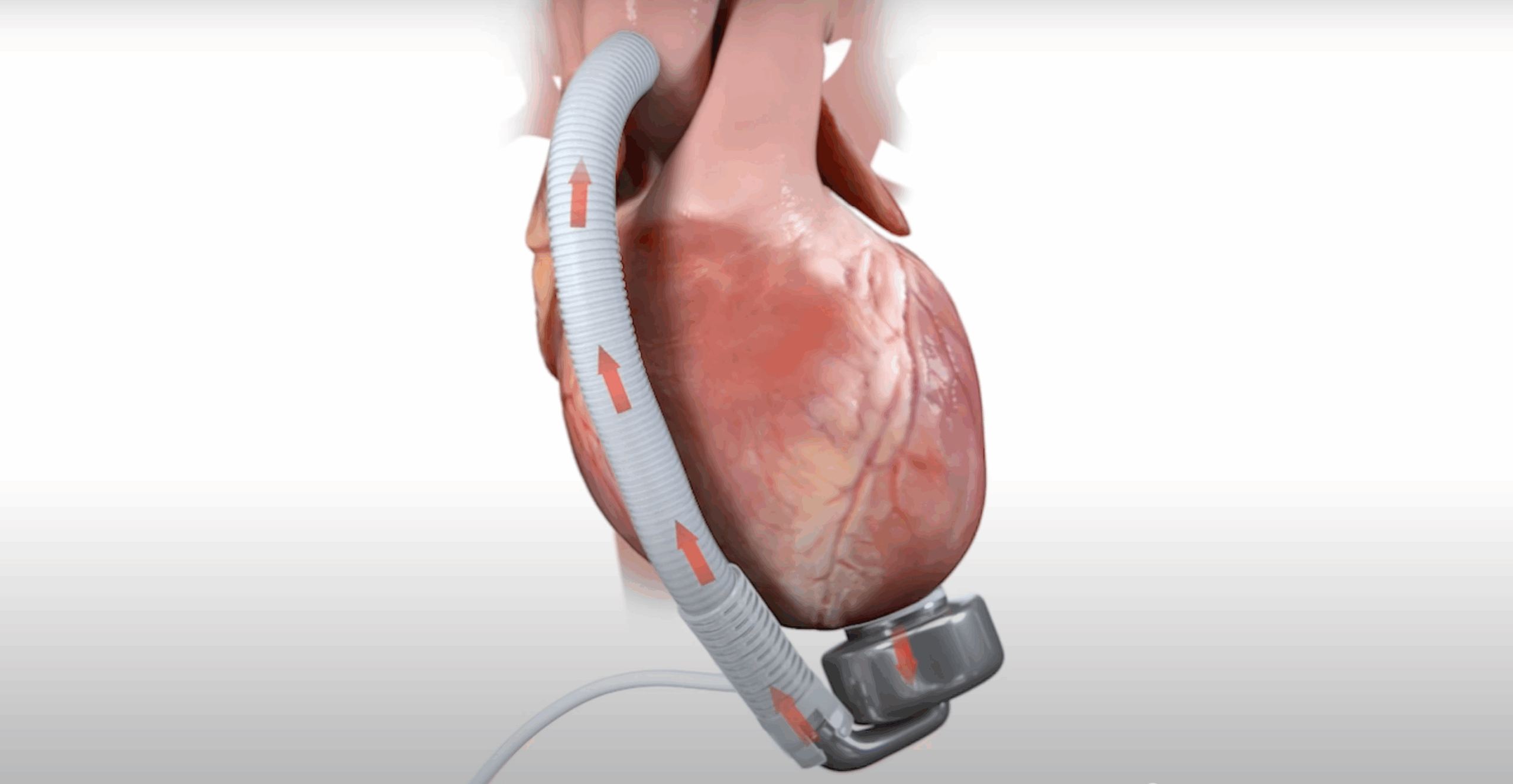 Prima pompă cardiacă cu membrană ondulată a fost implantată